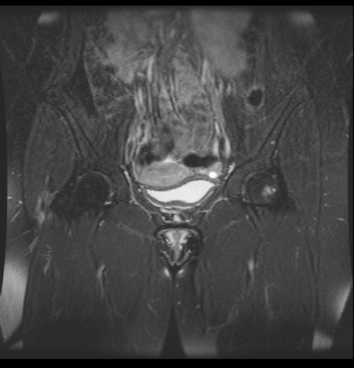 Gluteus minimus partial tear