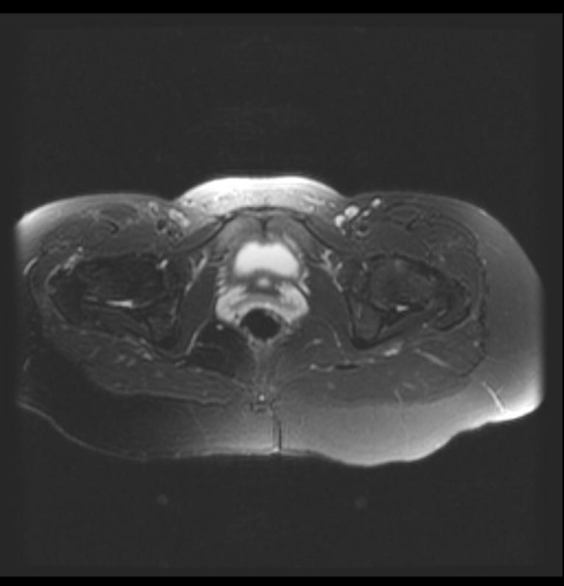 Gluteus minimus partial tear