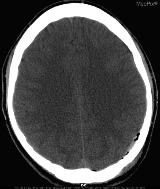 Acute Subdural Hematoma with temporal bone fracture