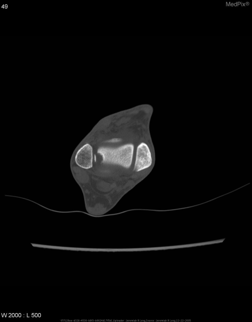 Osteochondritis Dissecans