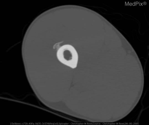 Bizarre Parosteal Osteochondromatous Proliferation