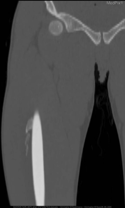 Bizarre Parosteal Osteochondromatous Proliferation