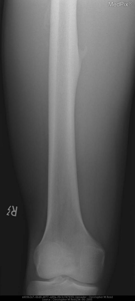 Bizarre Parosteal Osteochondromatous Proliferation