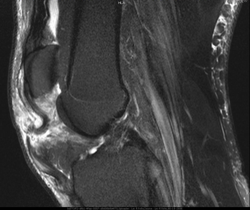 Disruption and tears of the patella tendons bilaterally.