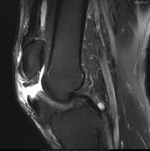 Disruption and tears of the patella tendons bilaterally.