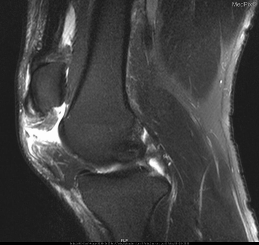 Disruption and tears of the patella tendons bilaterally.