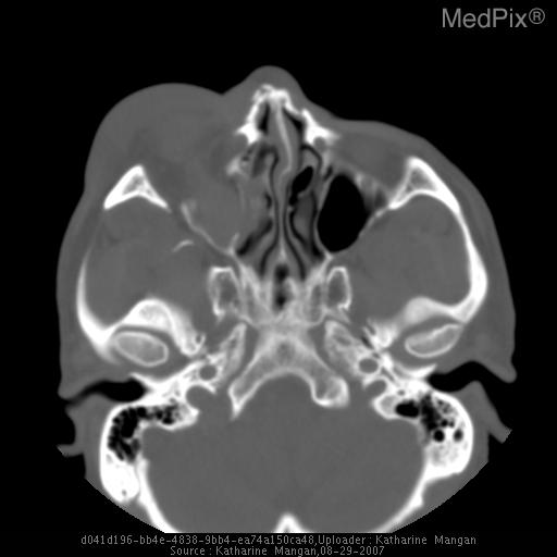 Orbit "blow-out" fracture