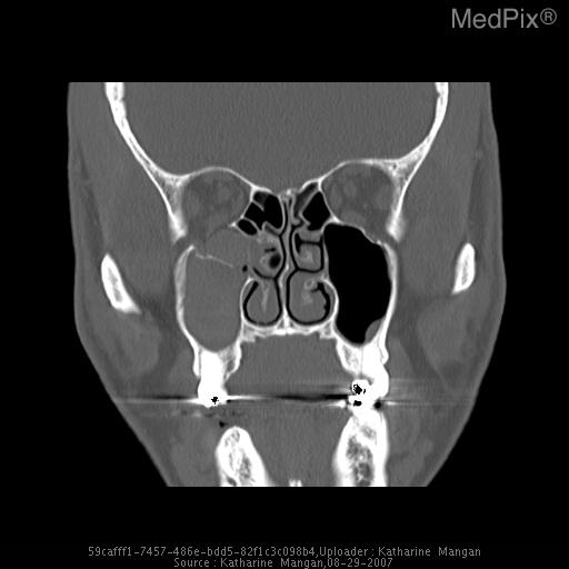 Orbit "blow-out" fracture