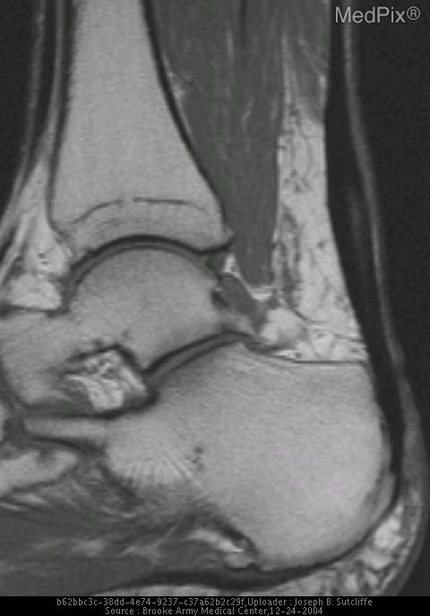 Partial Achilles Tendon tear