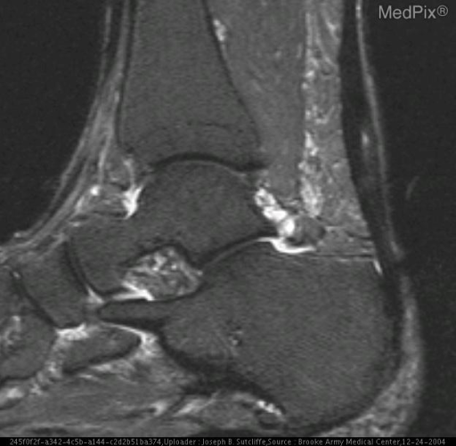 Partial Achilles Tendon tear