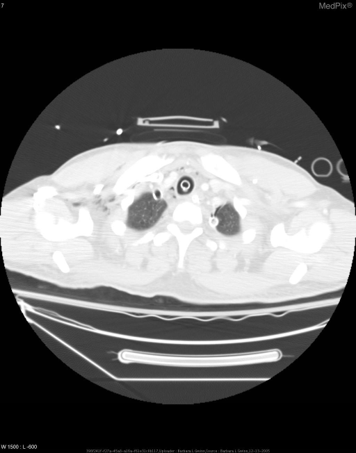 Pneumomediastinum from Blast Trauma