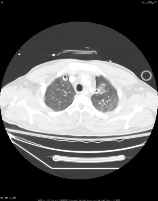 Pneumomediastinum from Blast Trauma