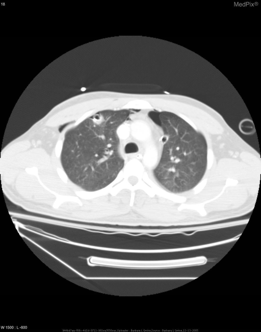 Pneumomediastinum from Blast Trauma