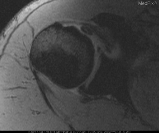 Biceps tendon dislocation; posterior to subscapularis.