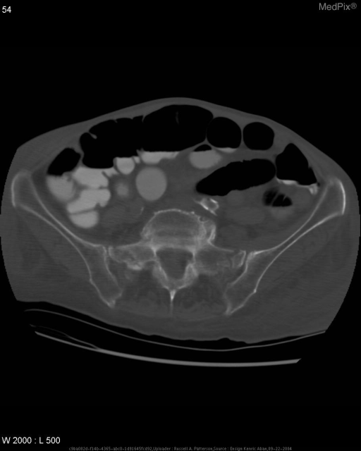 Bilateral sacral fractures