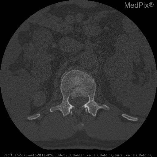 Burst Fracture of L1