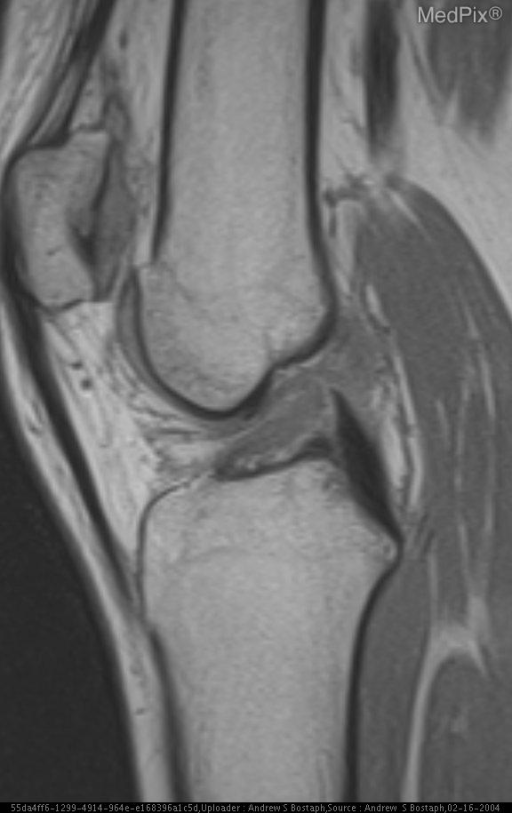 ACL Tear with lateral femoral notch sign