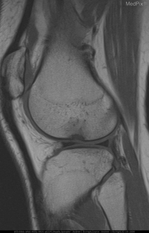 ACL Tear with lateral femoral notch sign