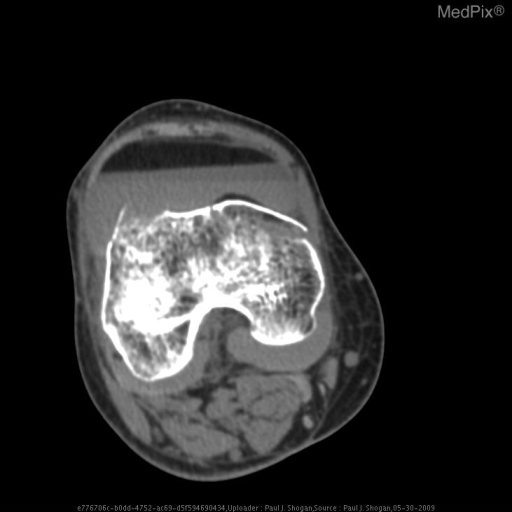 Lipohemarthrosis (s/p BKA for IED & shrapnel injury)