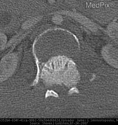 Fracture dislocation at thoraco-lumbar junction, resulting in spinal cord transection.