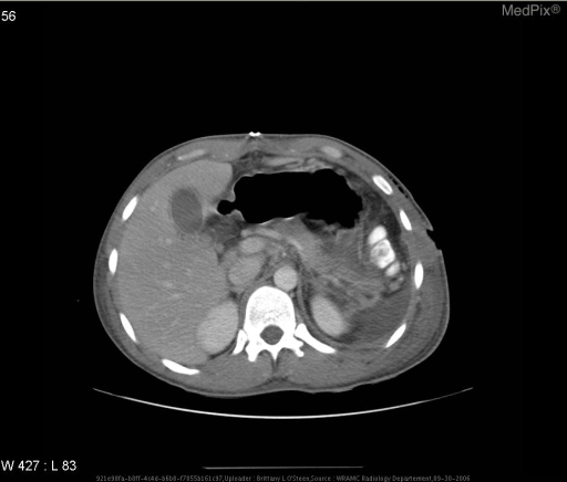 Bilateral pleural effusions, bilateral pelvic hematomas, fracture/tract of left iliac, Left 5th rib fracture, thickening of gastric wall - non-specific changes, and post surgical changes to left upper quadrent status post splenectomy.