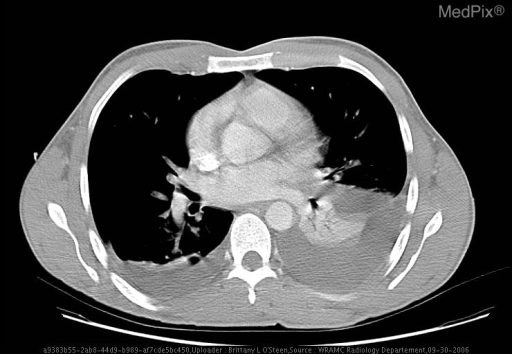 Bilateral pleural effusions, bilateral pelvic hematomas, fracture/tract of left iliac, Left 5th rib fracture, thickening of gastric wall - non-specific changes, and post surgical changes to left upper quadrent status post splenectomy.