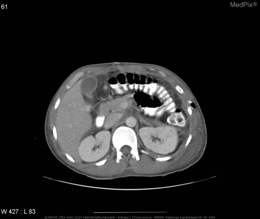 Bilateral pleural effusions, bilateral pelvic hematomas, fracture/tract of left iliac, Left 5th rib fracture, thickening of gastric wall - non-specific changes, and post surgical changes to left upper quadrent status post splenectomy.
