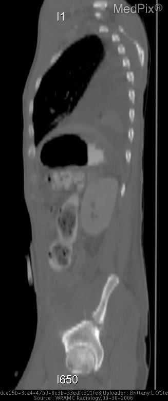 Bilateral pleural effusions, bilateral pelvic hematomas, fracture/tract of left iliac, Left 5th rib fracture, thickening of gastric wall - non-specific changes, and post surgical changes to left upper quadrent status post splenectomy.