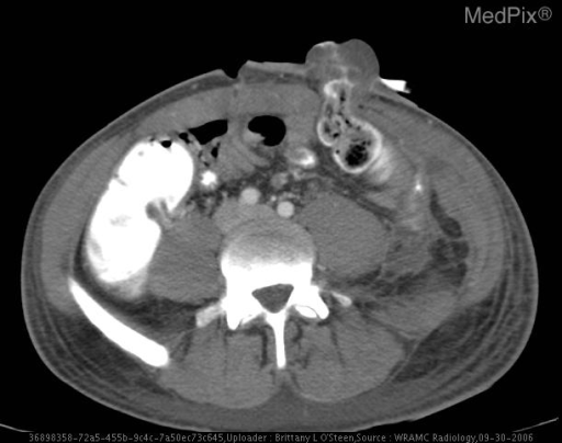Bilateral pleural effusions, bilateral pelvic hematomas, fracture/tract of left iliac, Left 5th rib fracture, thickening of gastric wall - non-specific changes, and post surgical changes to left upper quadrent status post splenectomy.