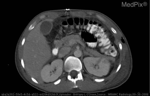 Bilateral pleural effusions, bilateral pelvic hematomas, fracture/tract of left iliac, Left 5th rib fracture, thickening of gastric wall - non-specific changes, and post surgical changes to left upper quadrent status post splenectomy.