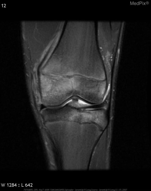 Salter-Harris Fracture