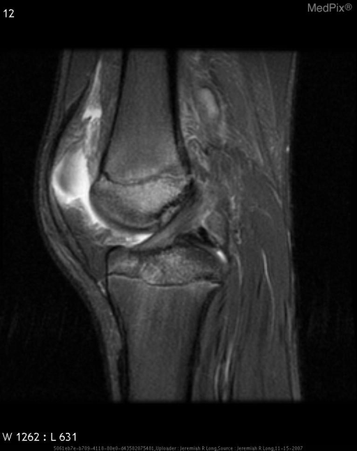 Salter-Harris Fracture