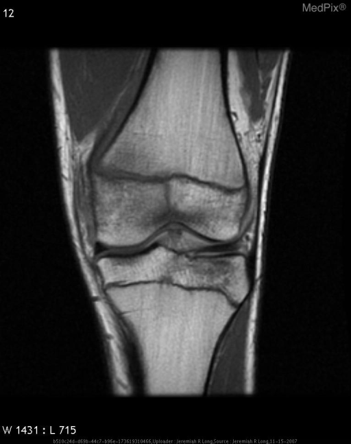 Salter-Harris Fracture
