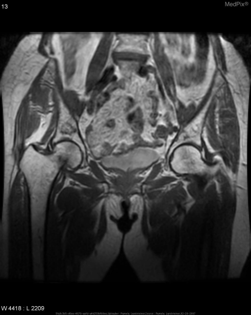 Non-displaced transverse fracture of right femoral neck.