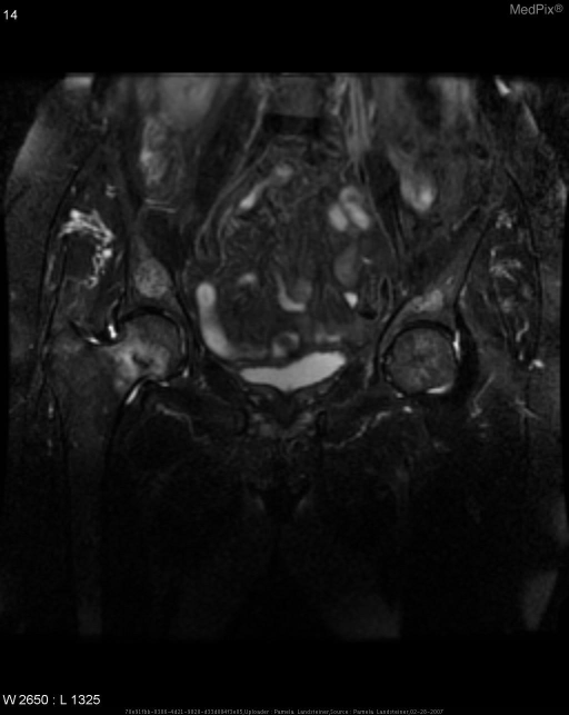 Non-displaced transverse fracture of right femoral neck.