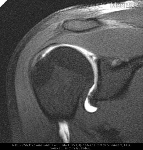 SLAP Lesion of the Glenoid Labrum
