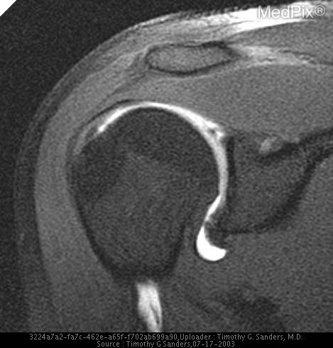 SLAP Lesion of the Glenoid Labrum