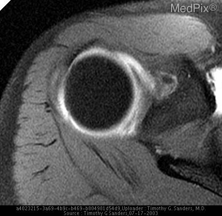 SLAP Lesion of the Glenoid Labrum