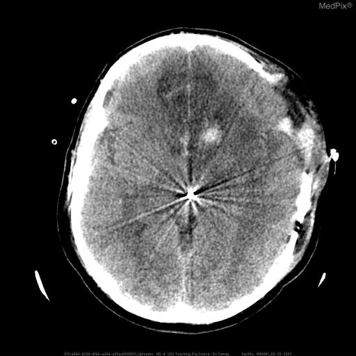 Surgical storage of craniotomy fragment pending definitive management