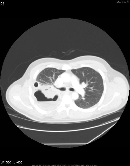 Bronchopleural Fistula