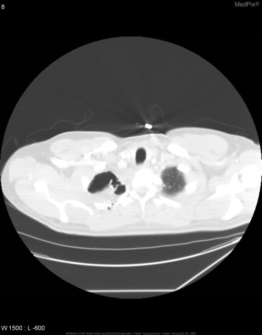 Bronchopleural Fistula