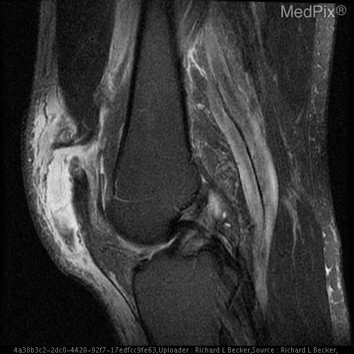 Quadriceps tendon rupture