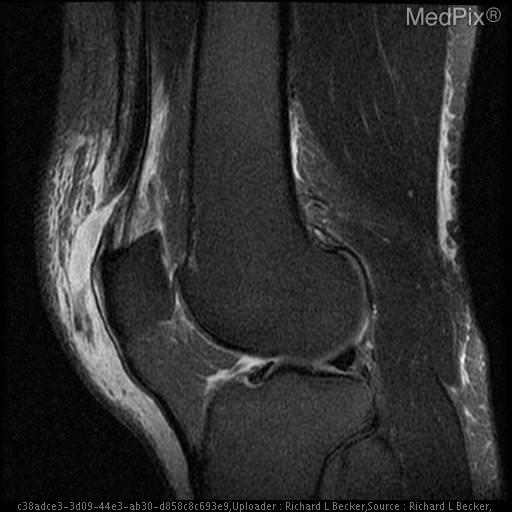 Quadriceps tendon rupture