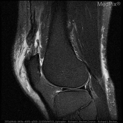 Quadriceps tendon rupture