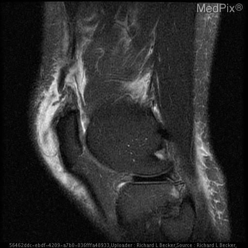 Quadriceps tendon rupture