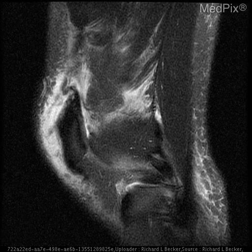 Quadriceps tendon rupture