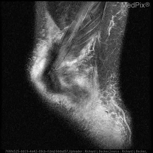 Quadriceps tendon rupture