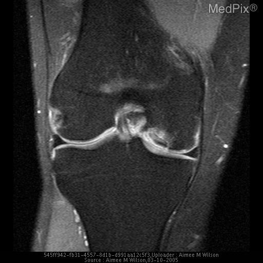 Osteochondritis Dissecans Stage IV