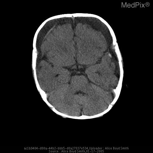 Battered child syndrome. Chronic bilateral subdural hematomas.