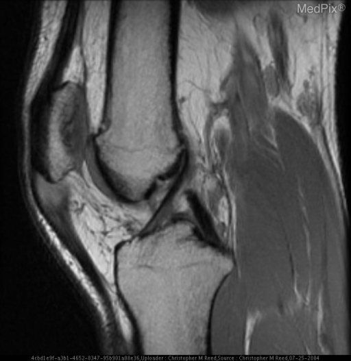 Patellar Tendinosis (Jumper's Knee) with probable partial tear of the patellar tendon.